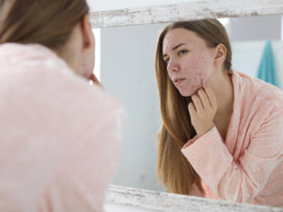 Rimedi per pelle rovinata dall’acne