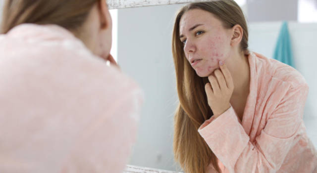 Come curare l&#8217;acne tardiva senza farmaci