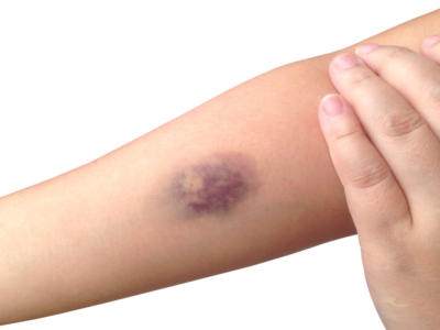 bollo livido braccio