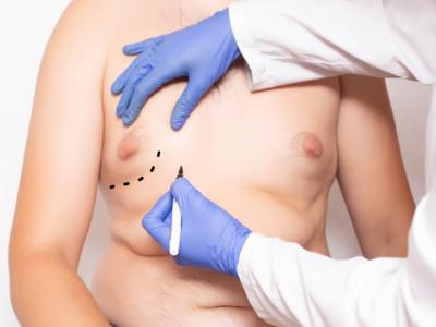 chirurgia uomo ginecomastia