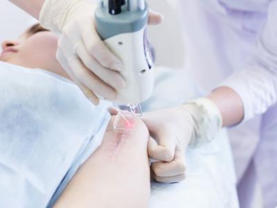 seduta laser eliminare cicatrici