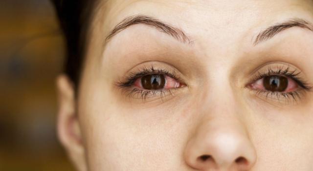 Da cosa dipende la lacrimazione agli occhi e come si allevia?