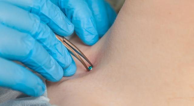 Come eliminare il microdermal piercing