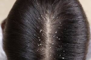 Persona con forfora visibile sulla cute e tra i capelli