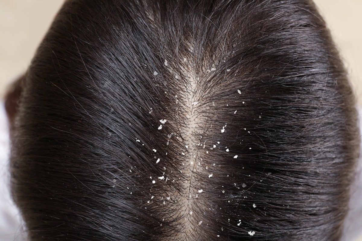 Persona con forfora visibile sulla cute e tra i capelli
