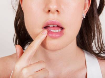 Come curare l’herpes alle labbra: i rimedi naturali che fanno miracoli!