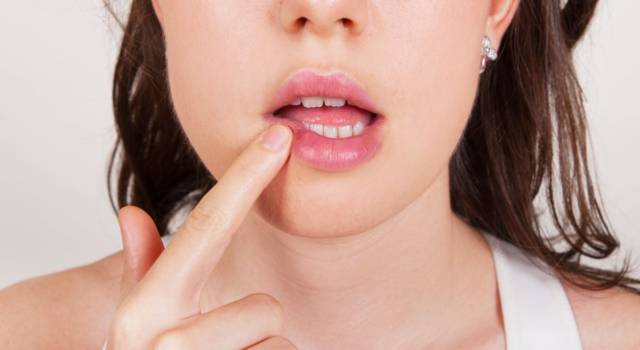 Come curare l&#8217;herpes alle labbra: i rimedi naturali che fanno miracoli!