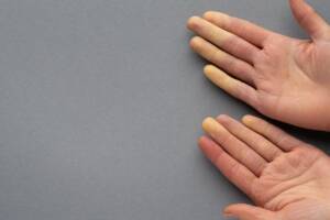 mani sindrome di raynaud