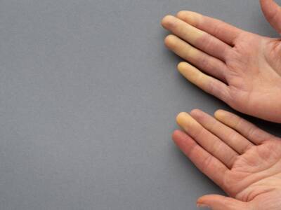 mani sindrome di raynaud