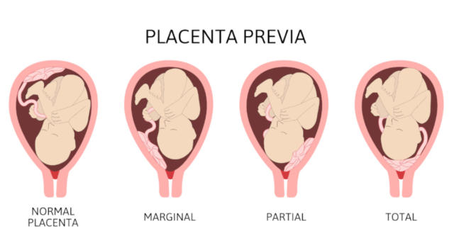 Cosa si intende per placenta previa e quali rischi comporta