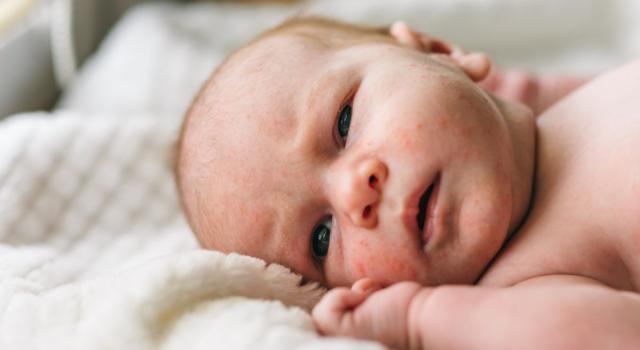 Cosa scatena l&#8217;acne neonatale e quali rimedi sono necessari?