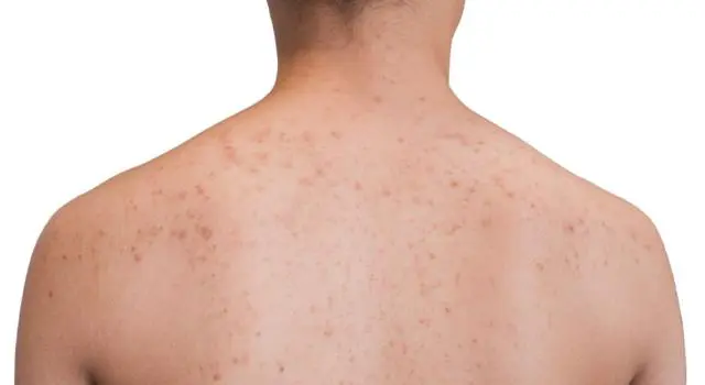 Puntini Rossi Sulla Pelle Cosa Sono E Come Prevenirli