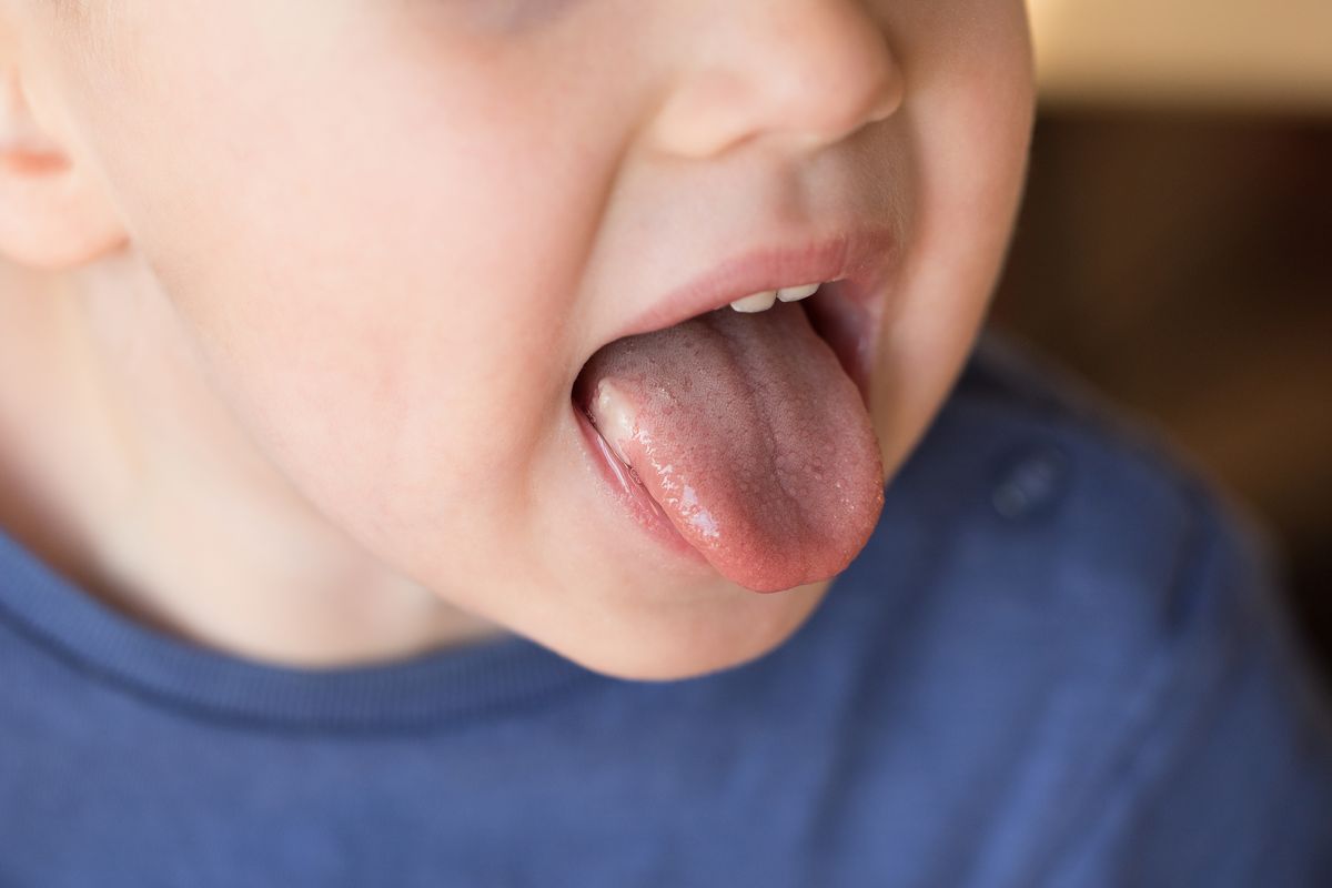 Bambino con stomatite alla lingua