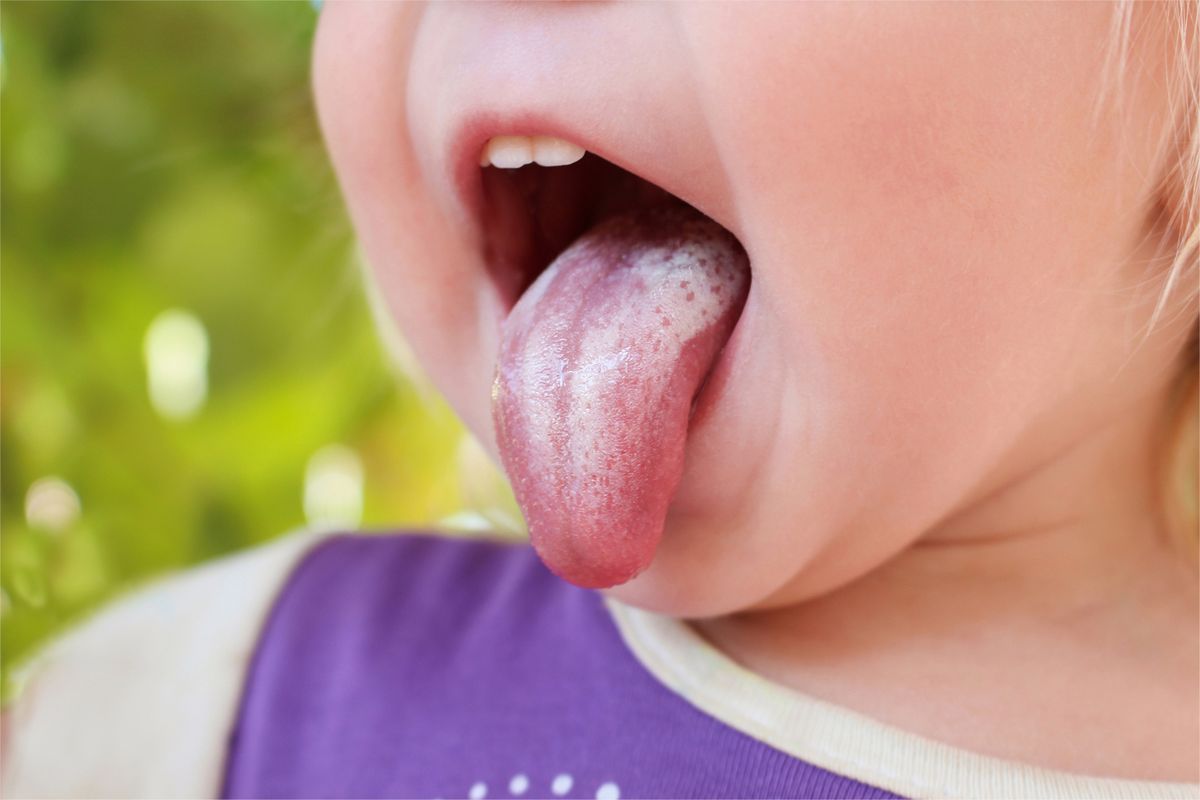 Bambino con lingua bianca