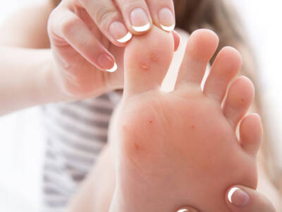 Calli ai piedi: tutti i rimedi naturali per prevenirli ed eliminarli