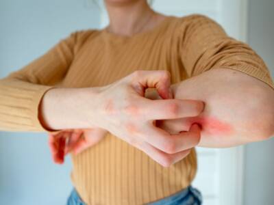prurito braccio sfogo