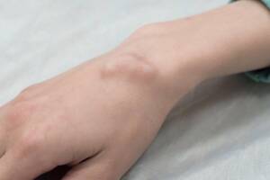 cisti tendinea