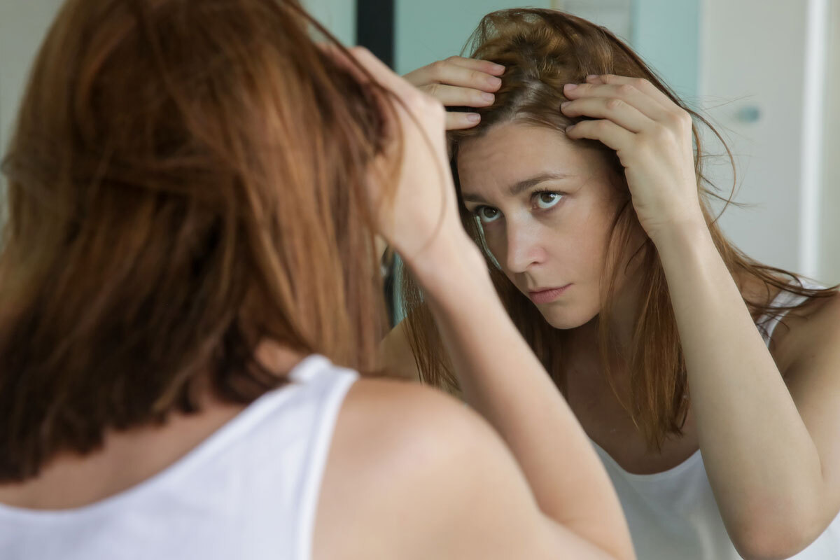 alopecia femminile rimedi