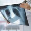 La tubercolosi torna a far paura: “E’ in ripresa, sta diventando multiresistente”