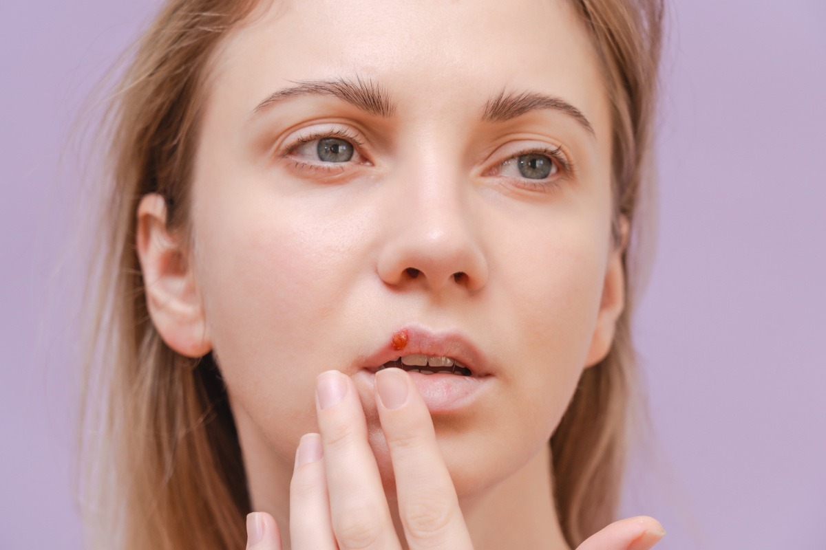 Herpes labiale, cosa fare subito: i rimedi della nonna per farlo sparire (senza medicinali)