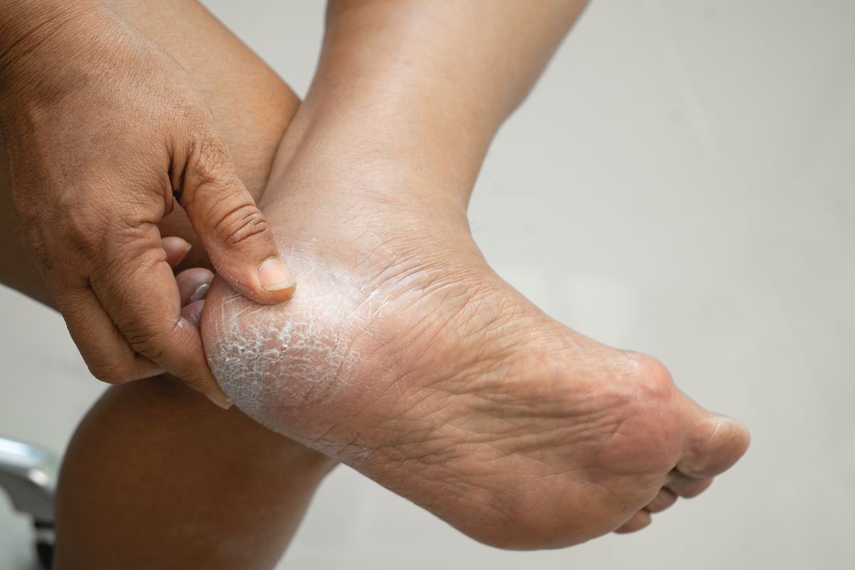 Piedi secchi con calli sul tallone