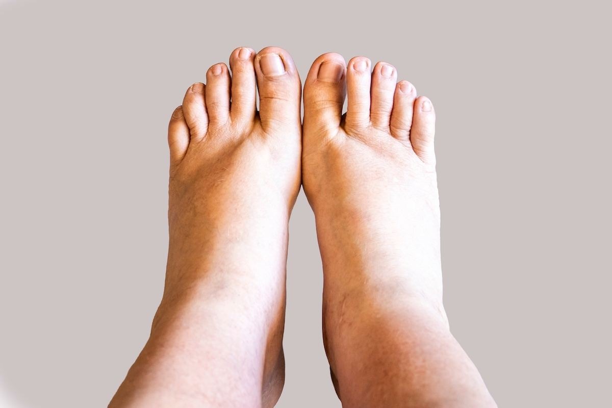 Piedi gonfi e caviglie con evidente gonfiore