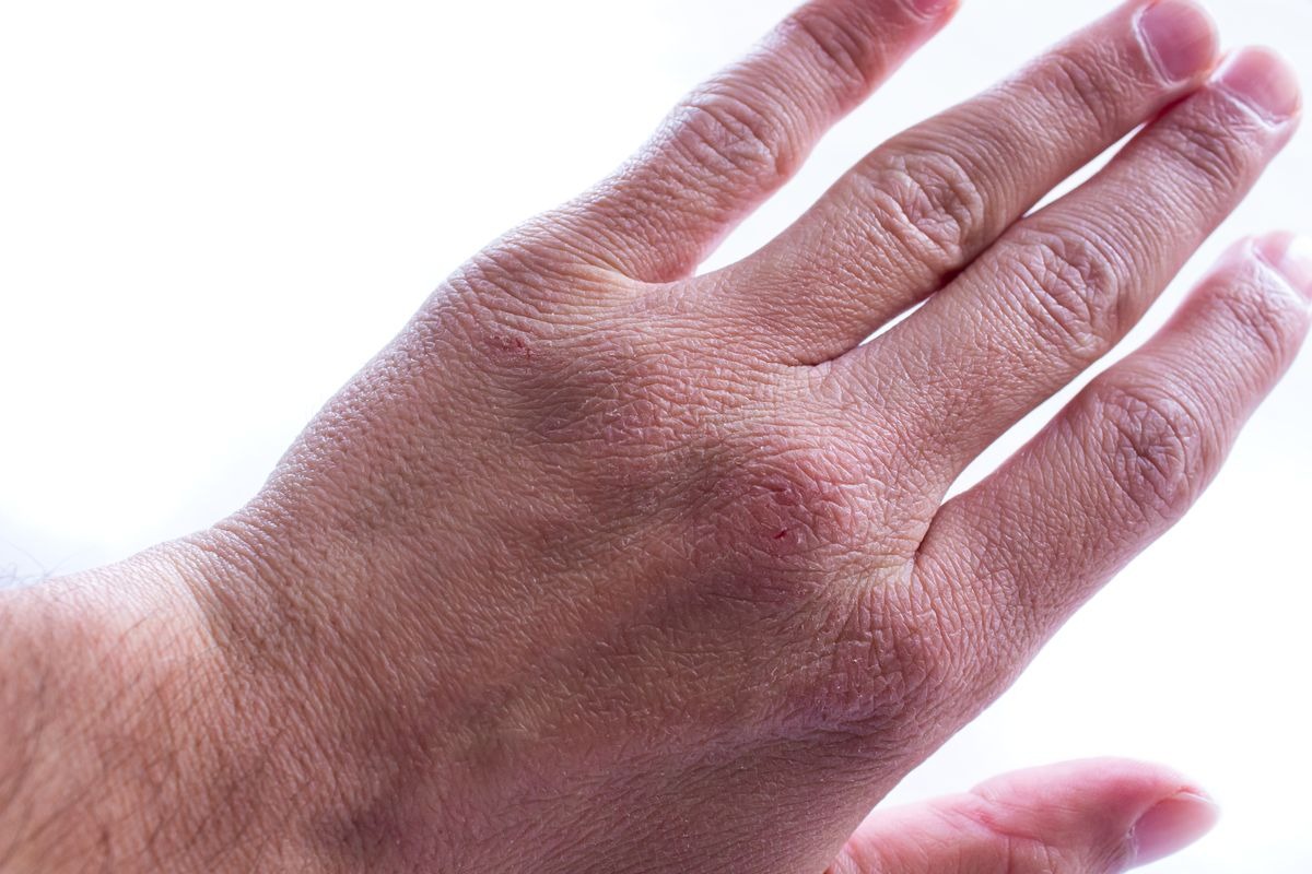 Primo piano di una mano screpolata e arrossata